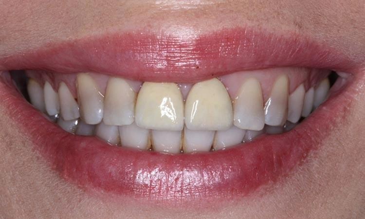 Răng sứ kim loại dễ bị ố vàng, đen viền nướu khi uống cà phê lâu dài.